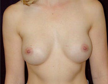 MTF Breast Augmentation Gallery - Patient 39235587 - Image 2