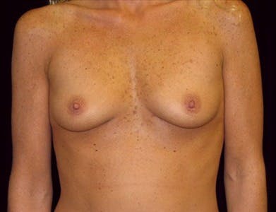 Breast Augmentation Gallery - Patient 39244072 - Image 1