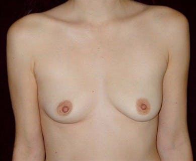 Breast Augmentation Gallery - Patient 39244123 - Image 1