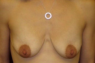 Breast Augmentation Gallery - Patient 39244131 - Image 1