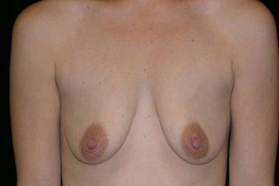 Breast Augmentation Gallery - Patient 39244133 - Image 1