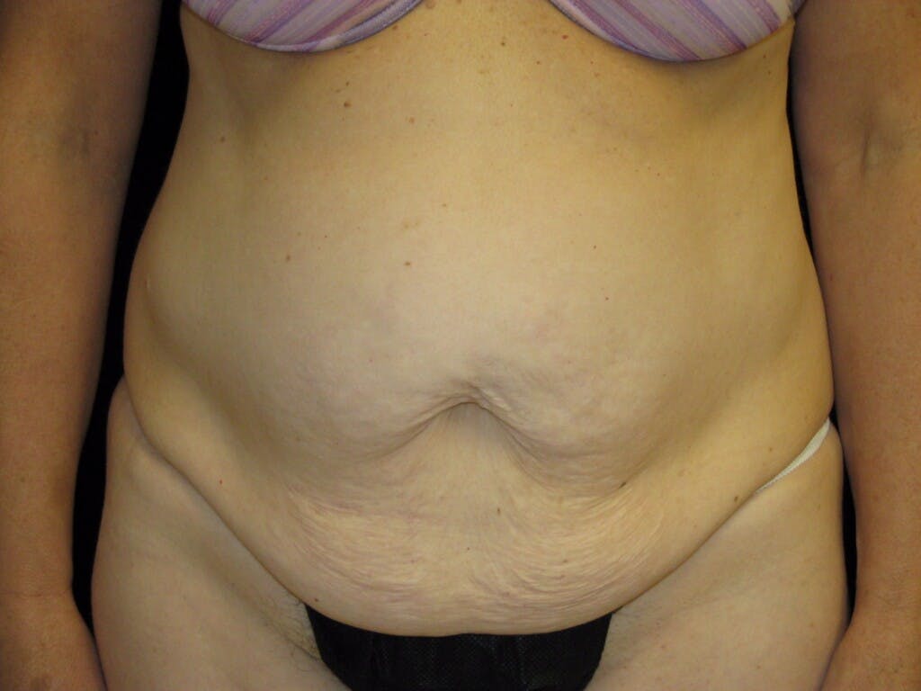 Tummy Tuck Gallery - Patient 39244170 - Image 1