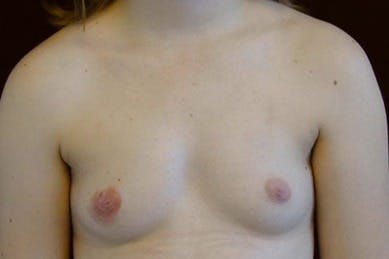 Breast Augmentation Gallery - Patient 39244167 - Image 1