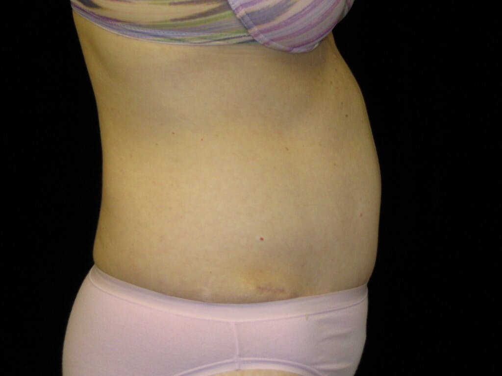 Tummy Tuck Gallery - Patient 39244170 - Image 6