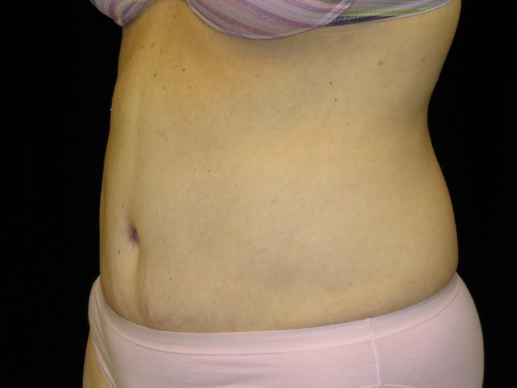 Tummy Tuck Gallery - Patient 39244170 - Image 8