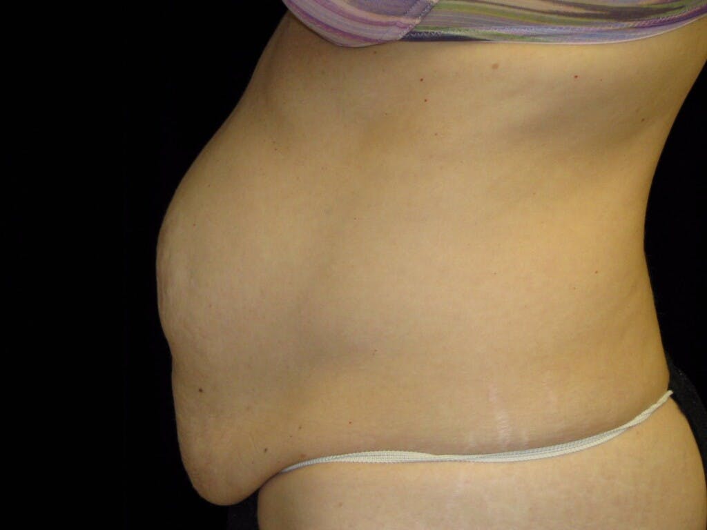 Tummy Tuck Gallery - Patient 39244170 - Image 9