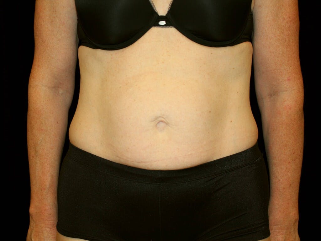 Tummy Tuck Gallery - Patient 39244177 - Image 1
