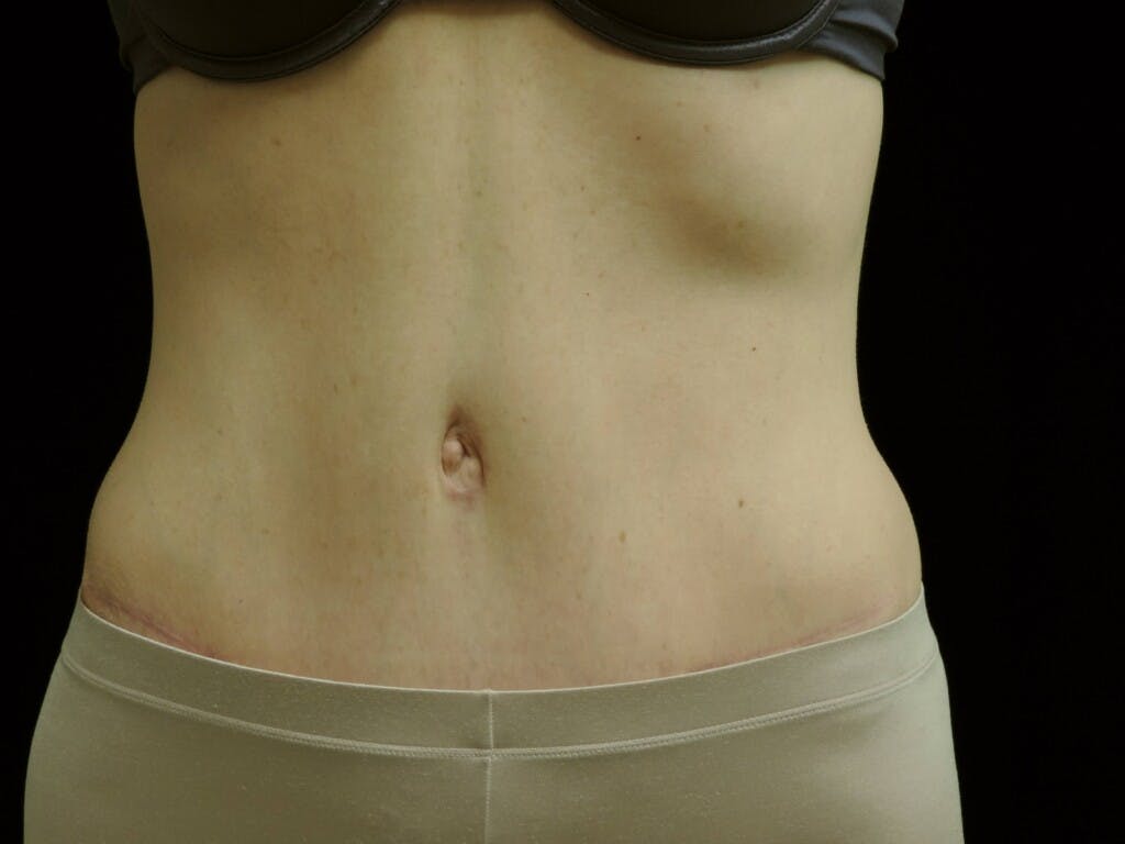 Tummy Tuck Gallery - Patient 39244177 - Image 2