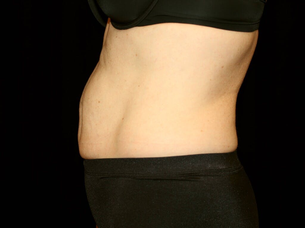 Tummy Tuck Gallery - Patient 39244177 - Image 9