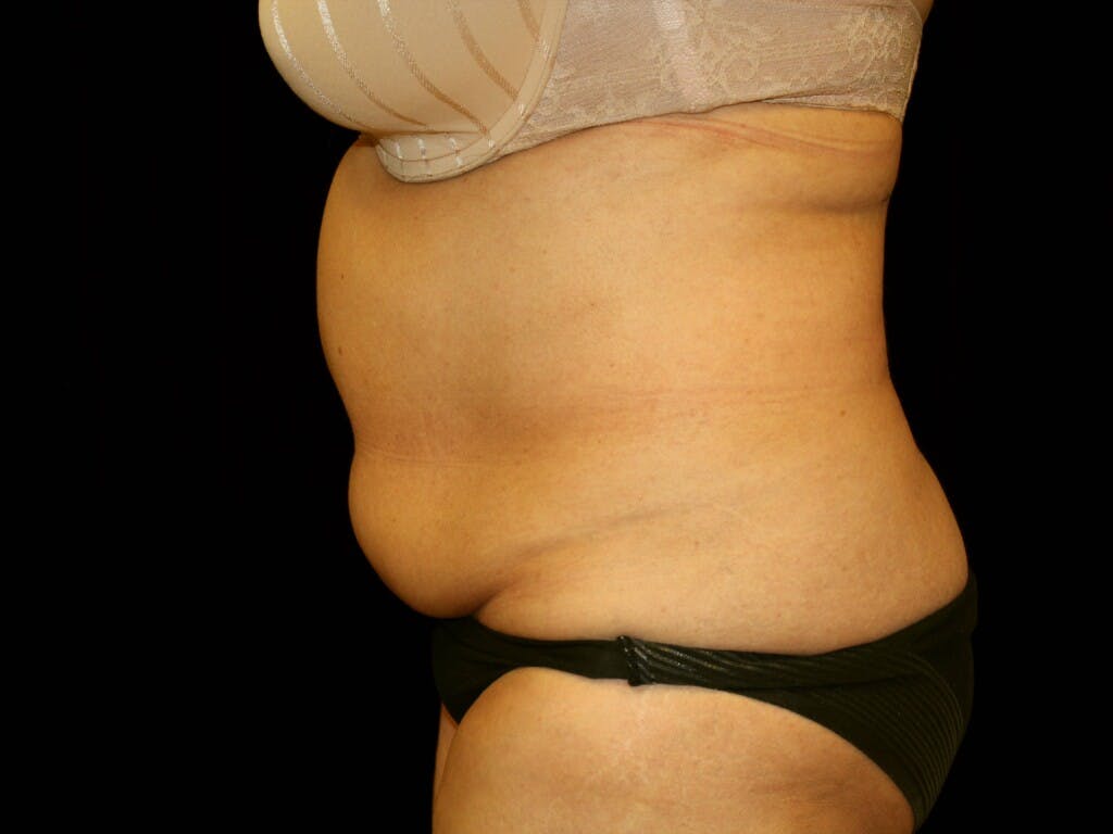 Tummy Tuck Gallery - Patient 39244342 - Image 7