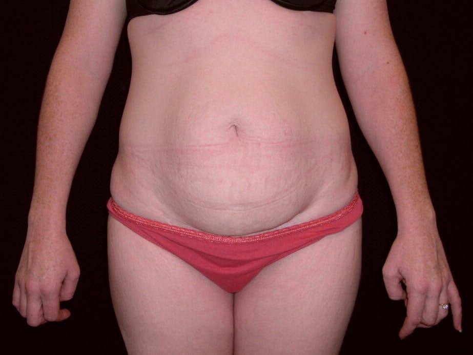 Tummy Tuck Gallery - Patient 39244346 - Image 1