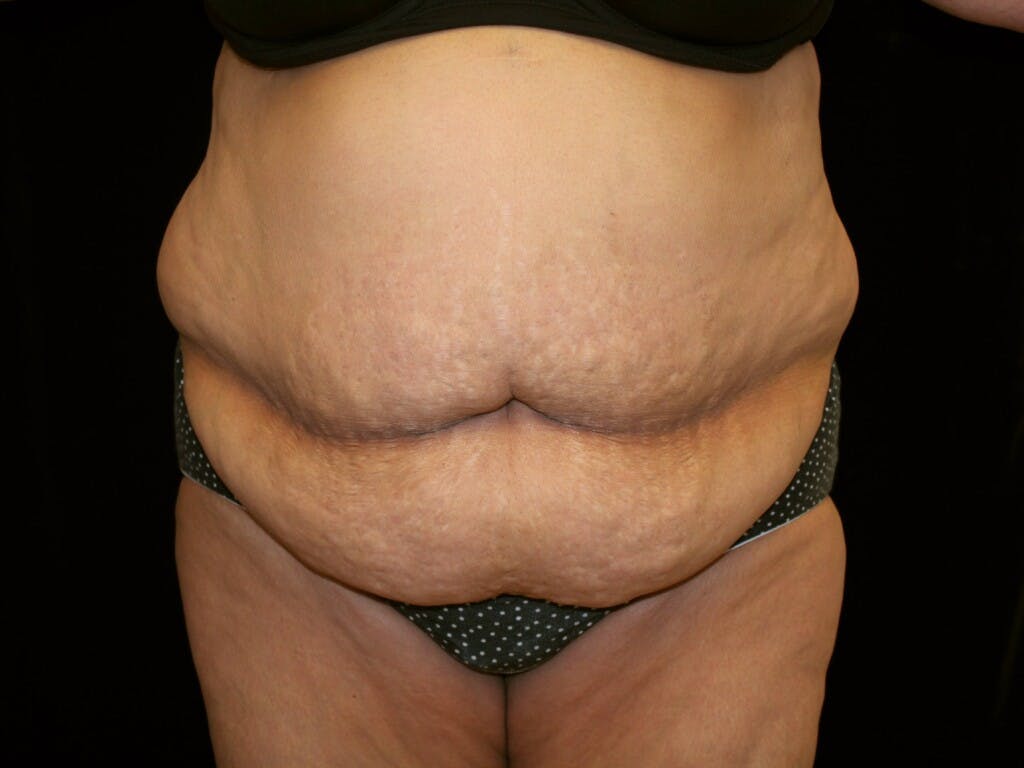 Tummy Tuck Gallery - Patient 39244359 - Image 1