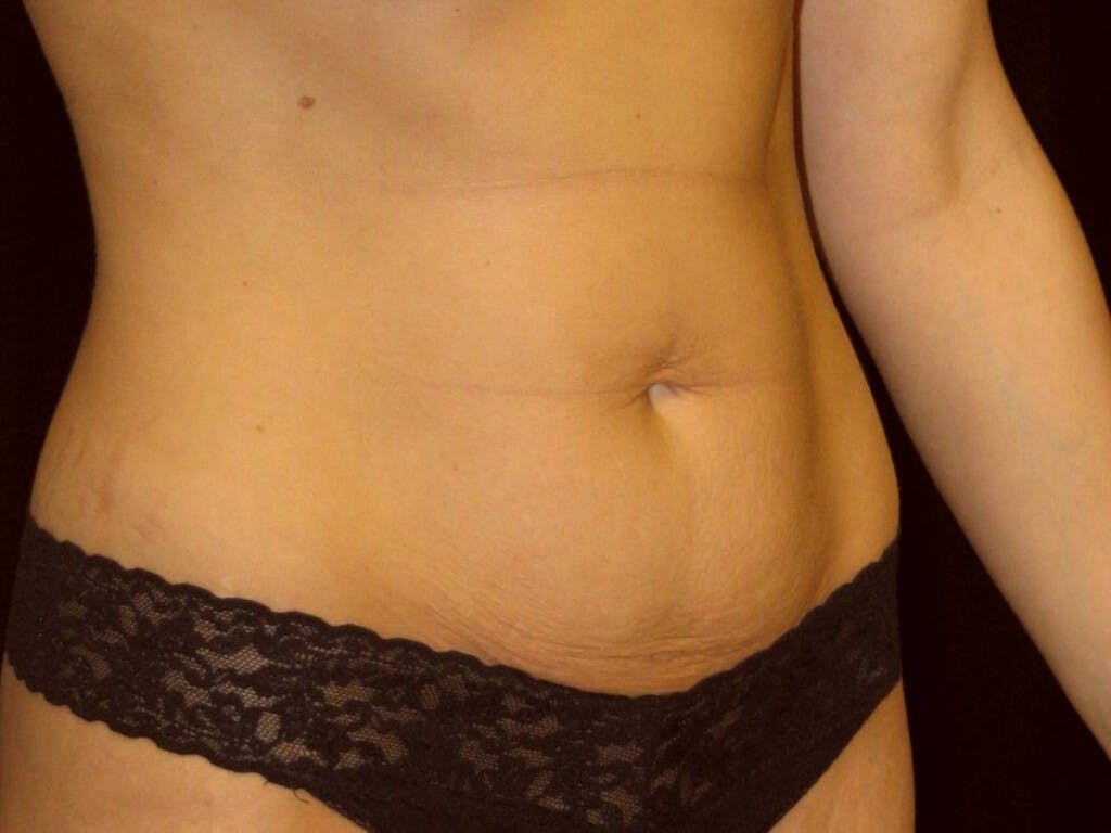 Tummy Tuck Gallery - Patient 39245233 - Image 3
