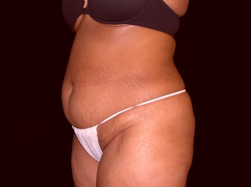 Tummy Tuck Gallery - Patient 39245240 - Image 1