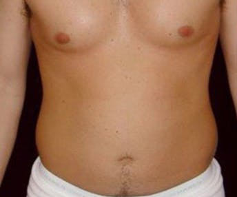 Male Liposuction Gallery - Patient 39245448 - Image 1