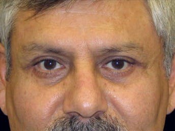 Eyelid Surgery for Men