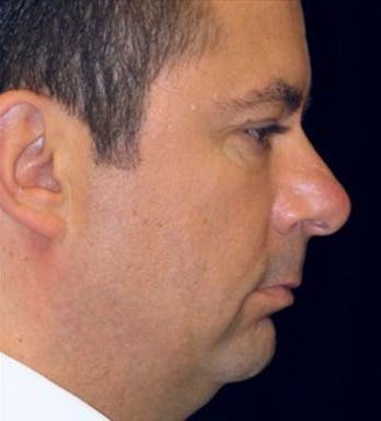 Male Chin Augmentation Gallery - Patient 39245458 - Image 1