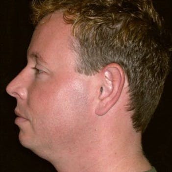 Male Neck Lift Gallery - Patient 39245467 - Image 1