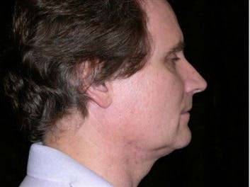 Male Facelift Gallery - Patient 39245471 - Image 1