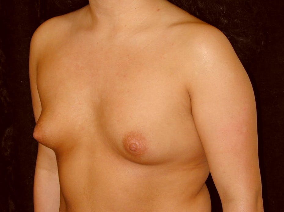 Breast Augmentation Gallery - Patient 39246059 - Image 7