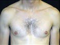 Gynecomastia Gallery - Patient 39350126 - Image 1