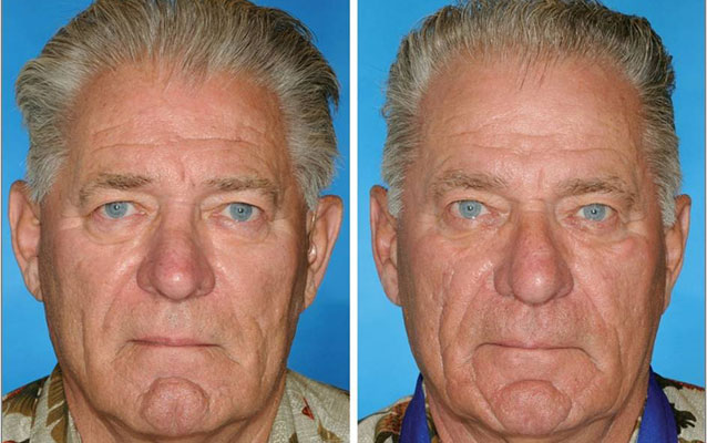 Both twins are smokers. The twin on the right smoked 14 years longer than his brother.