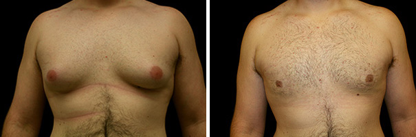 Before and after gynecomastia surgery
