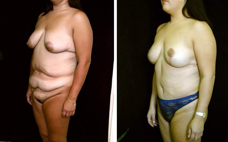 Before and After Mommy Makeover