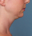 Before Kybella Injections in San Francisco