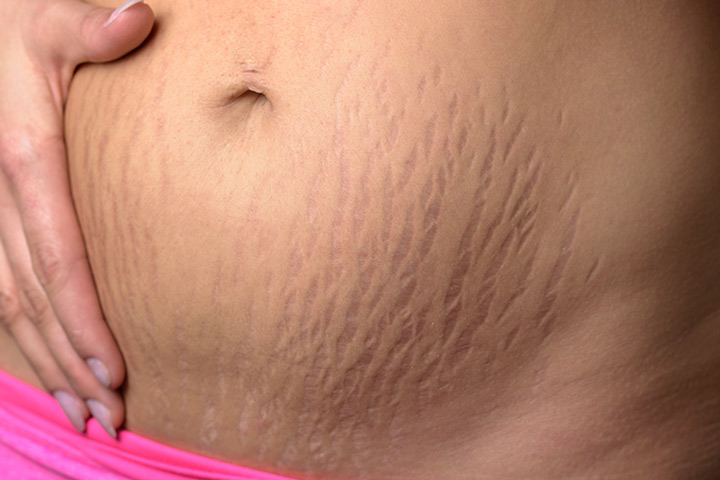 Stretch marks from pregnancy in San Francisco