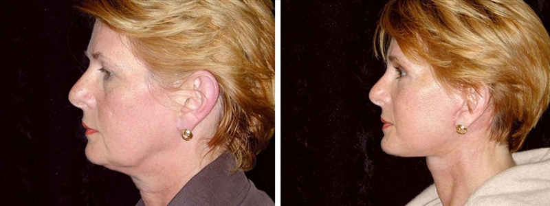 Aging face before and after Facelift San Francisco