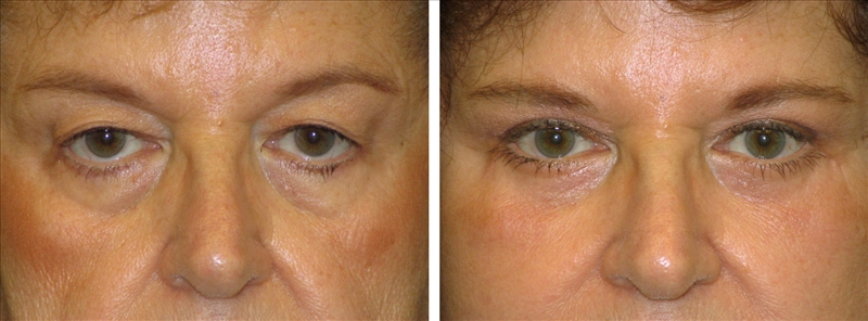 Before and After Blepharoplasty