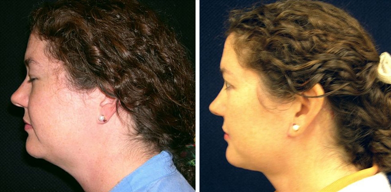 Neck lift in San Francisco
