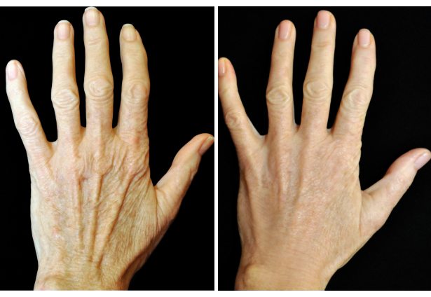 Radiesse for Hands in San Francisco
