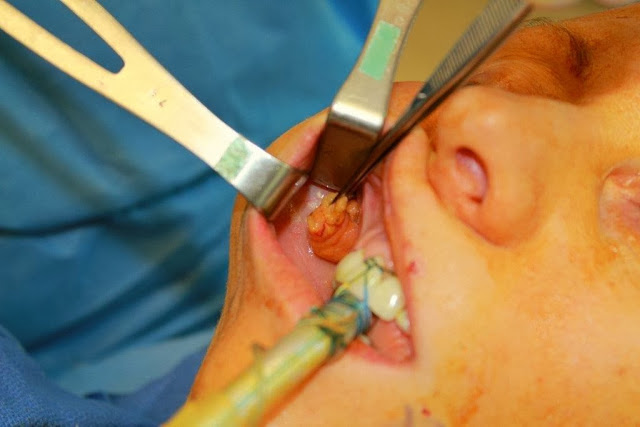 Buccal Fat Pad removal