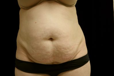 How To Get Rid Of A Belly Pooch After Pregnancy