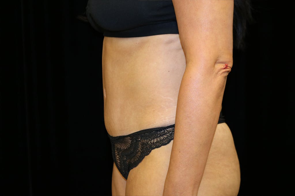 Liposuction Gallery - Patient 93317663 - Image 10