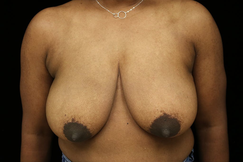 Breast Reduction T Incision Gallery - Patient 93317666 - Image 1