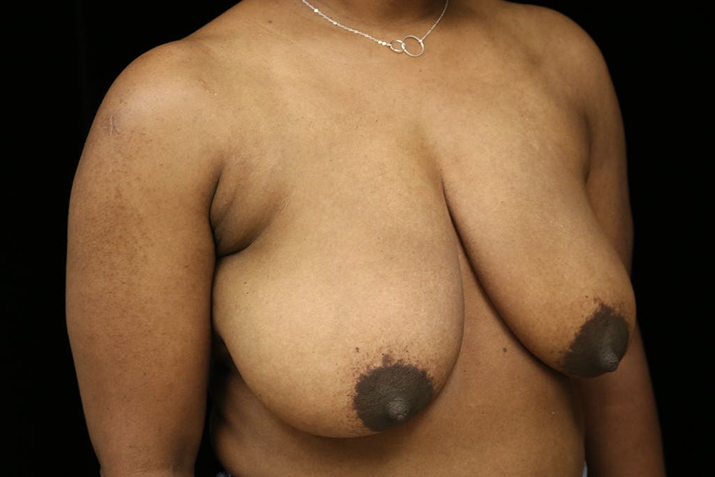 Breast Reduction T Incision Gallery - Patient 93317666 - Image 3