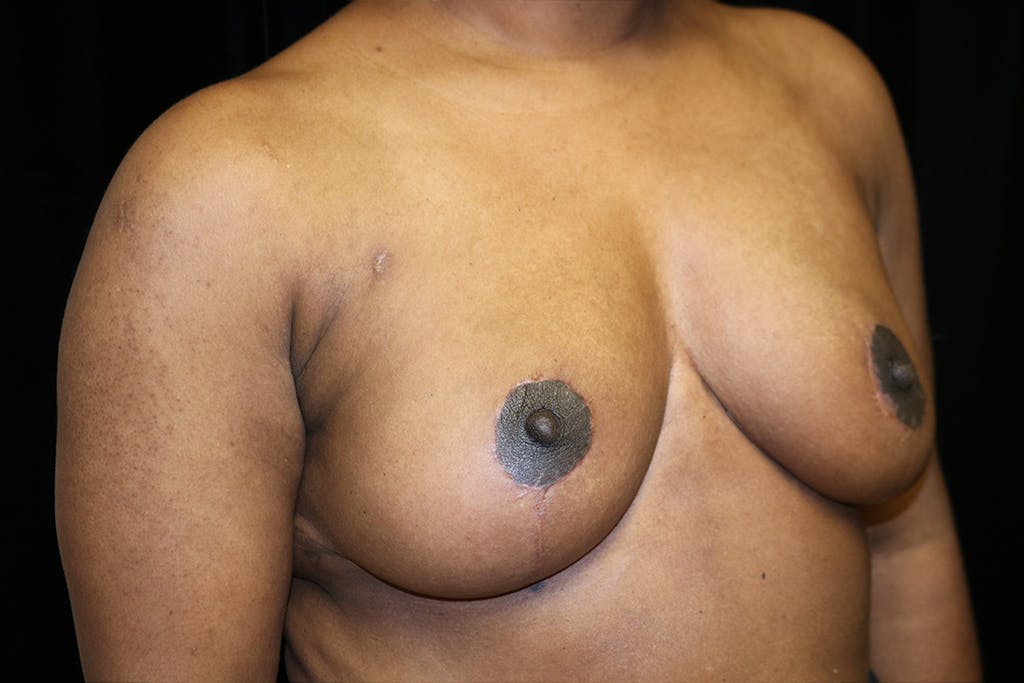 Breast Reduction T Incision Gallery - Patient 93317666 - Image 4
