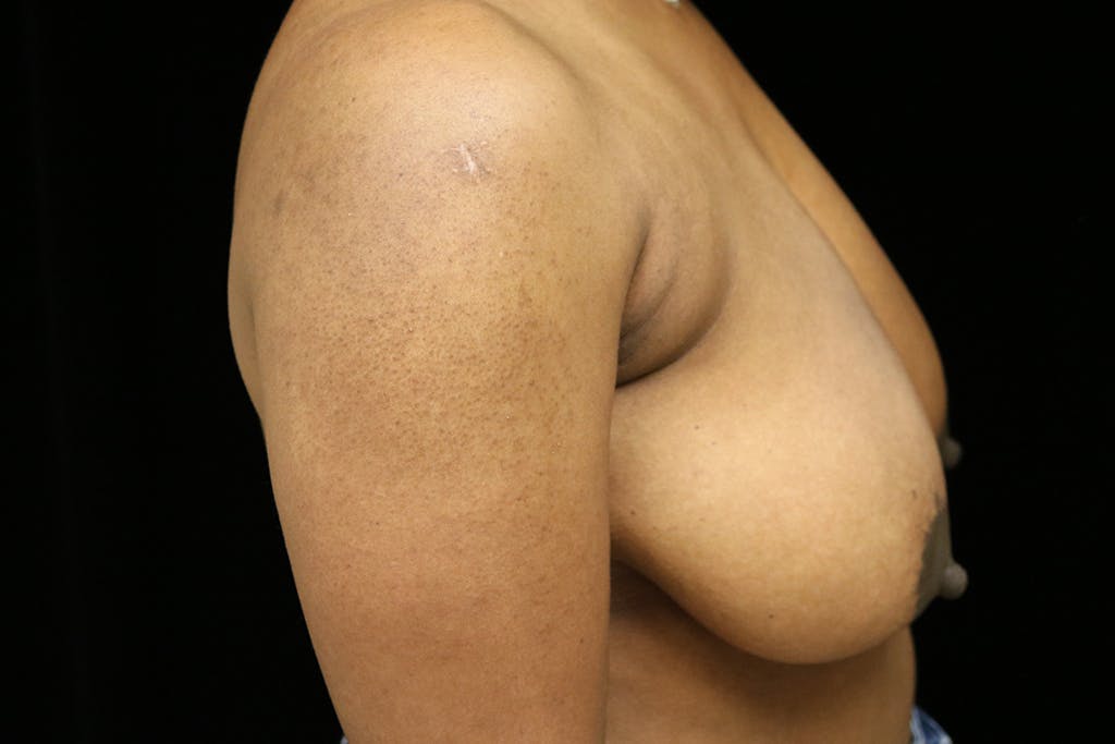 Breast Reduction T Incision Gallery - Patient 93317666 - Image 5