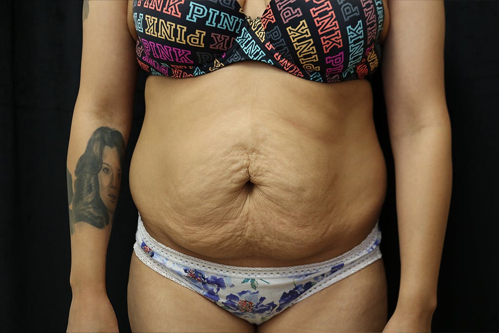 Liposuction Gallery - Patient 93317799 - Image 1