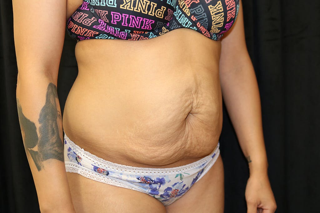 Tummy Tuck Gallery - Patient 93317798 - Image 3