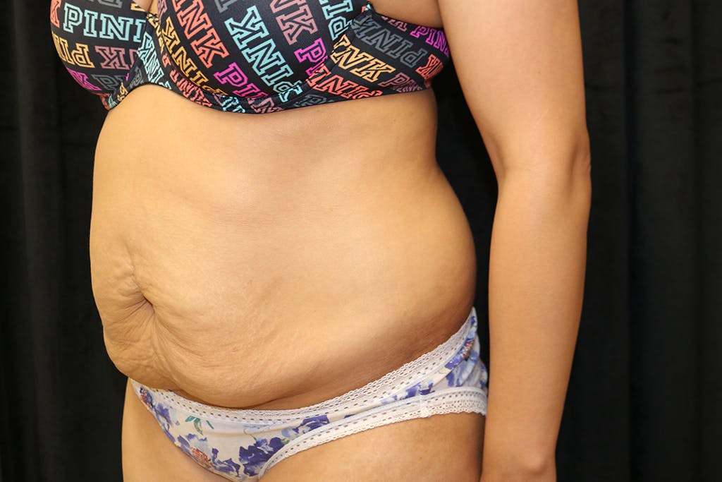 Liposuction Gallery - Patient 93317799 - Image 5