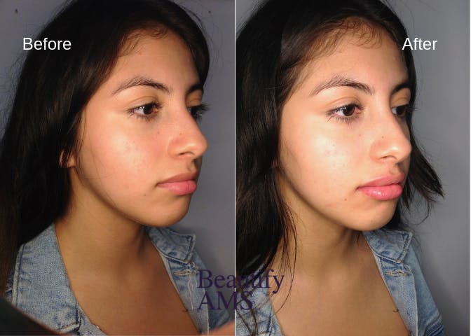 Lip Enhancement  Before & After Gallery - Patient 123746031 - Image 1