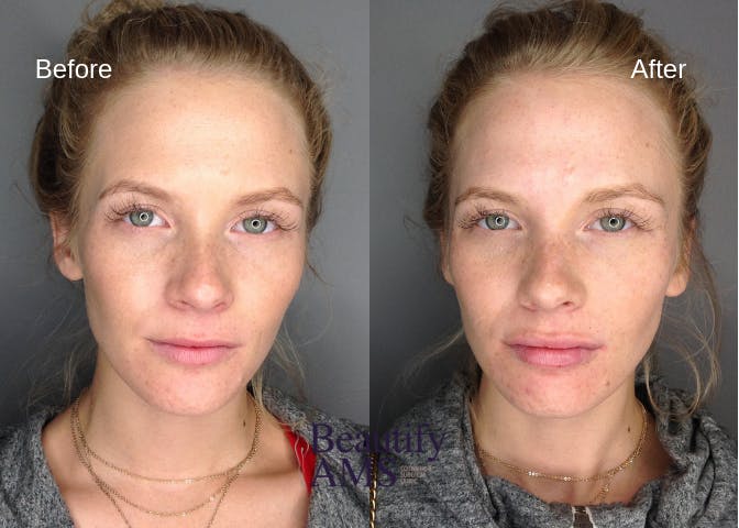 Lip Enhancement  Before & After Gallery - Patient 123746028 - Image 1