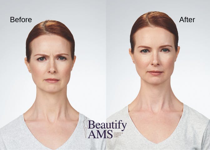 Botox Before & After Gallery - Patient 123746024 - Image 1