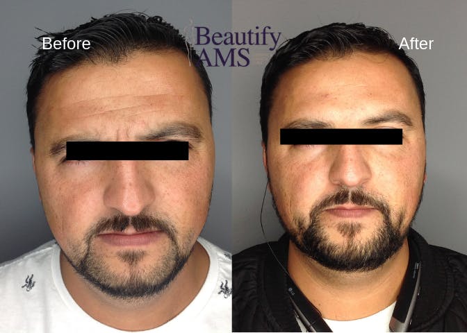 BroTox Before & After Gallery - Patient 123746033 - Image 1