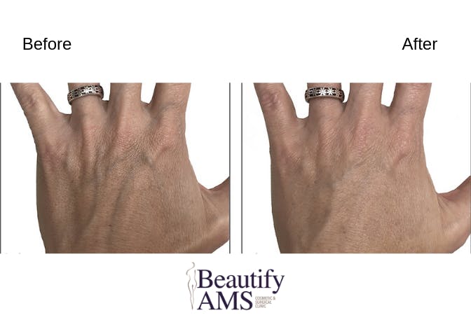 Hand Rejuvenation  Before & After Gallery - Patient 123746020 - Image 1