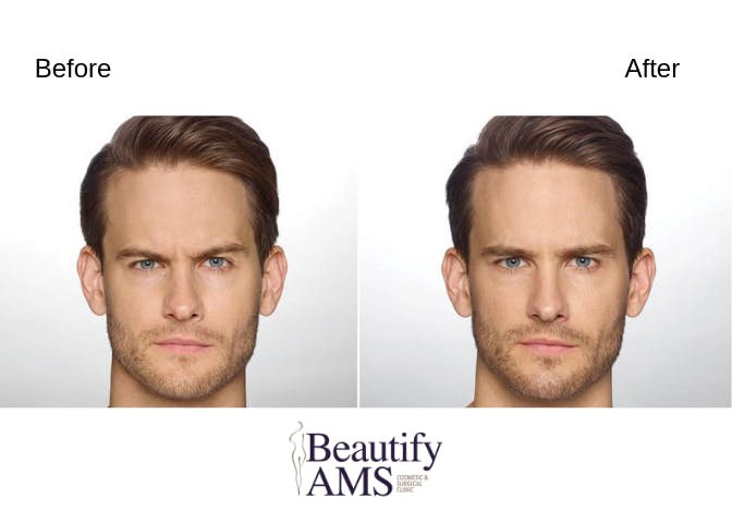 BroTox Before & After Gallery - Patient 123746018 - Image 1